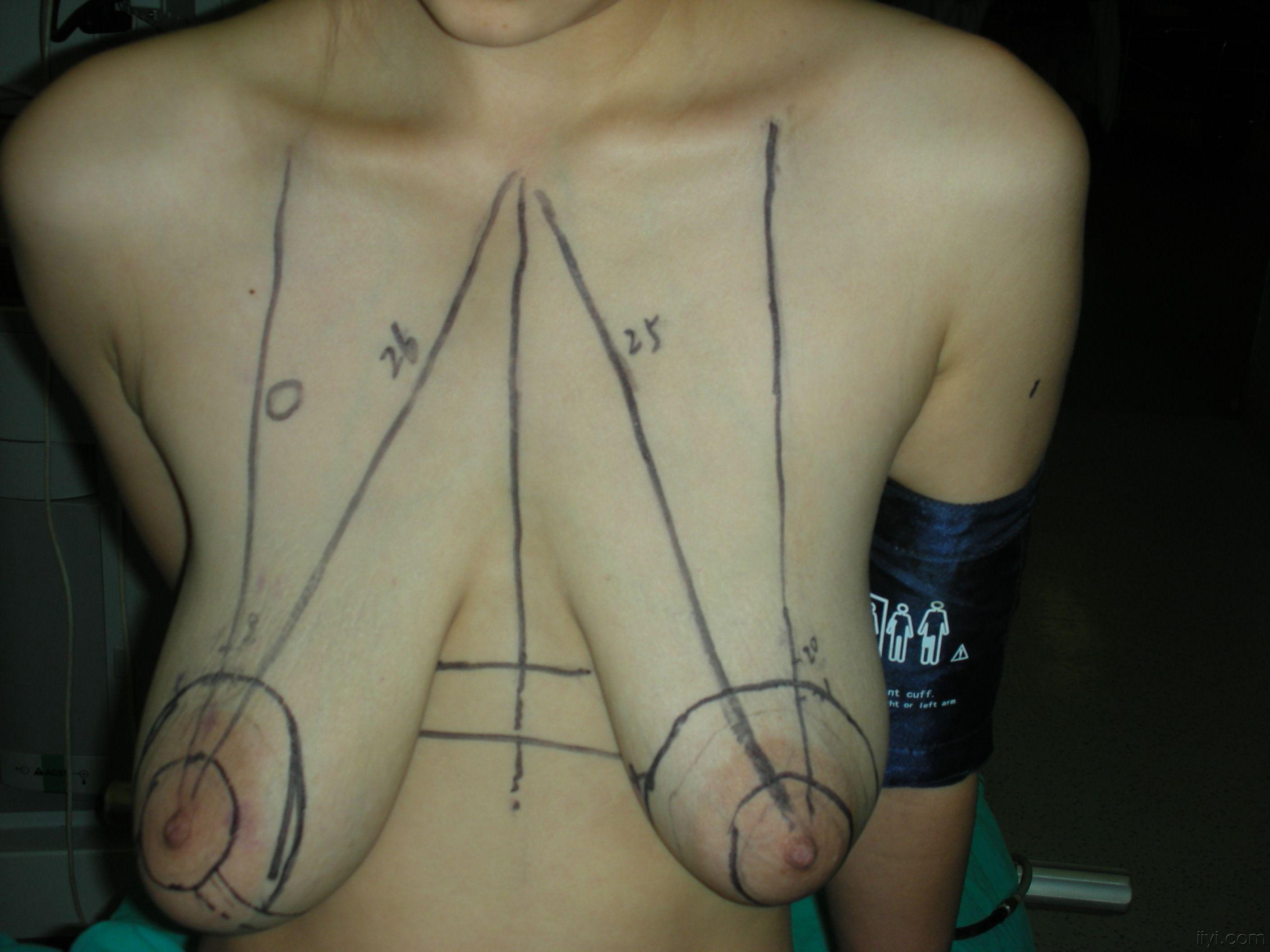 平胸手术后的照片 平胸手术恢复图