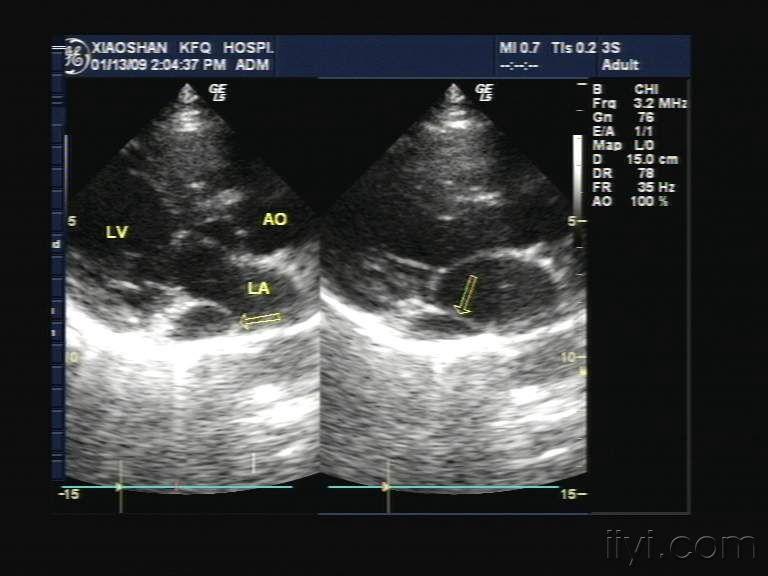 左室长轴切面,左房室沟处可见