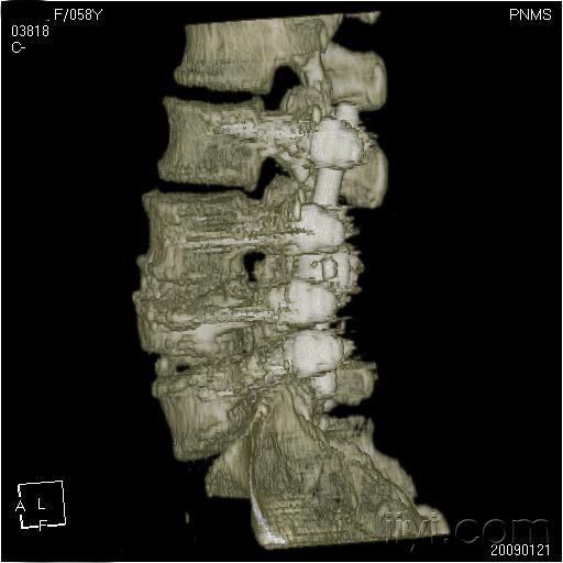 腰椎结核术后三维图片欣赏