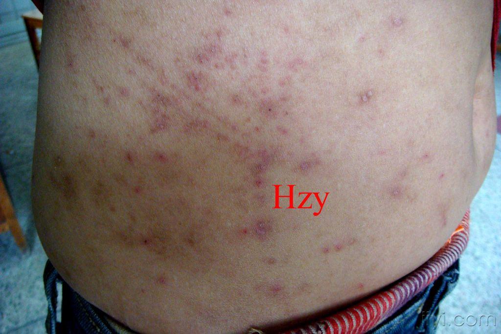 躯干瘙痒半个月右上肢皮损一周