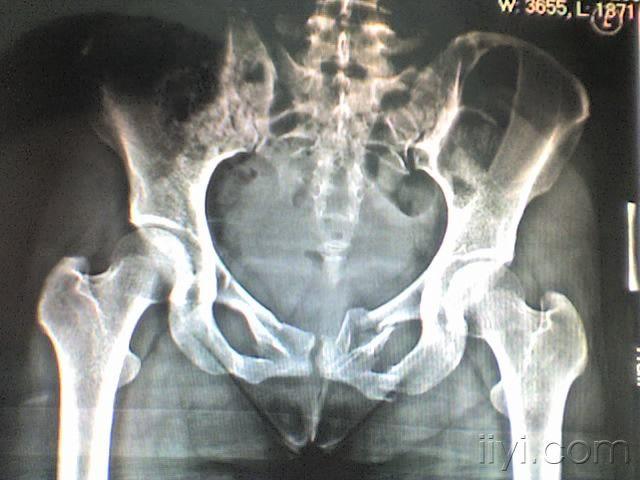 右耻骨上支骨折图片 搜狗图片搜索