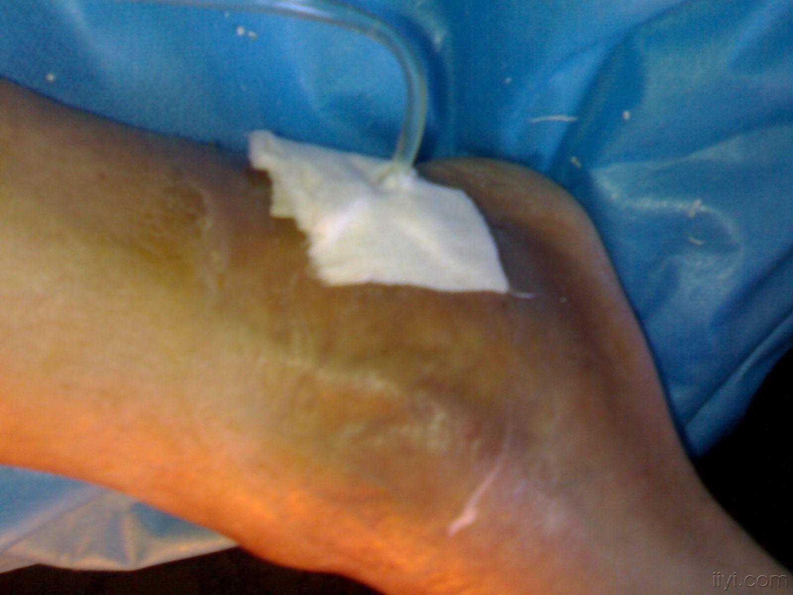 求踝关节骨髓炎治疗方案(附图片和x光片)