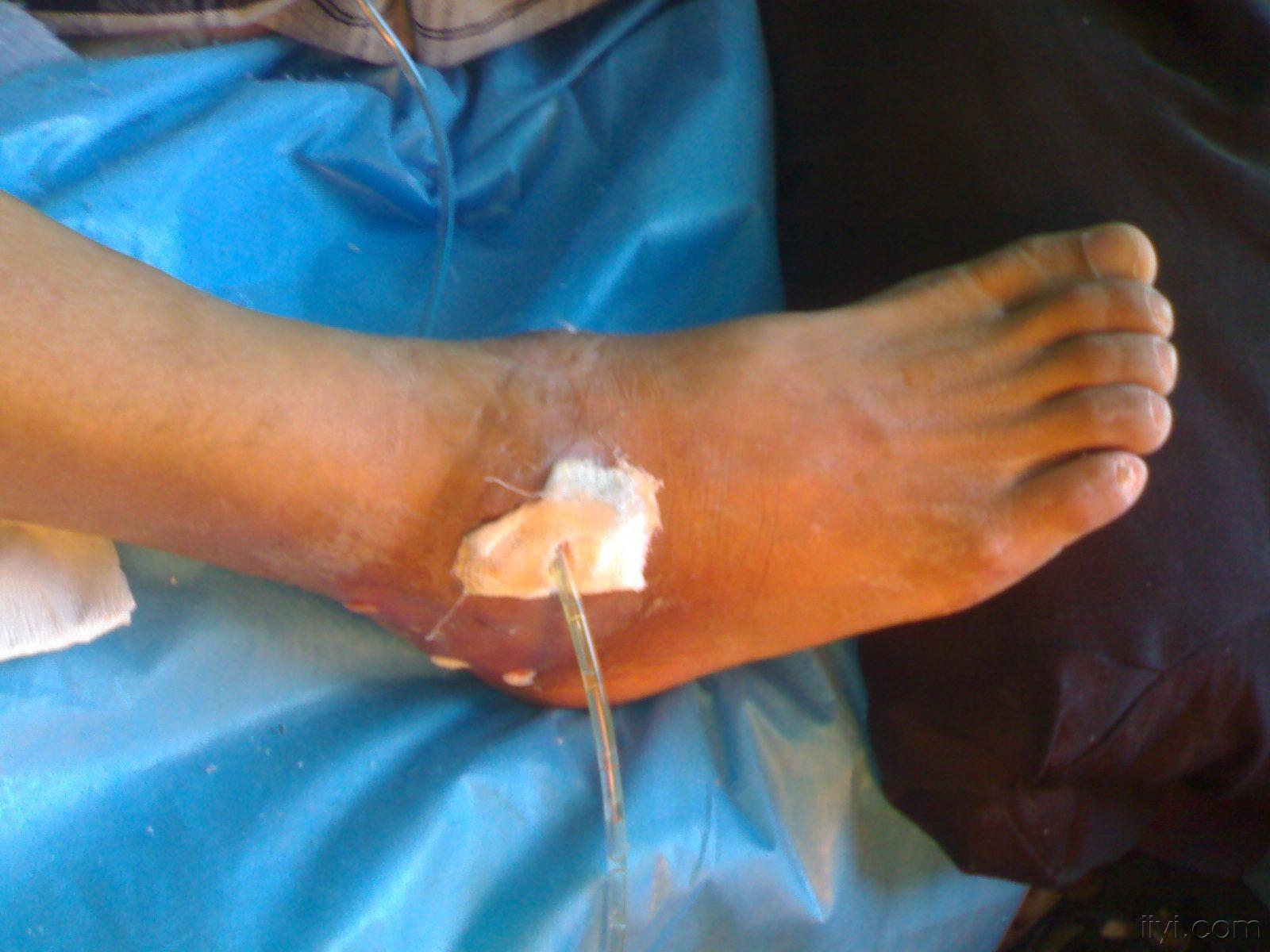 求踝关节骨髓炎治疗方案(附图片和x光片)