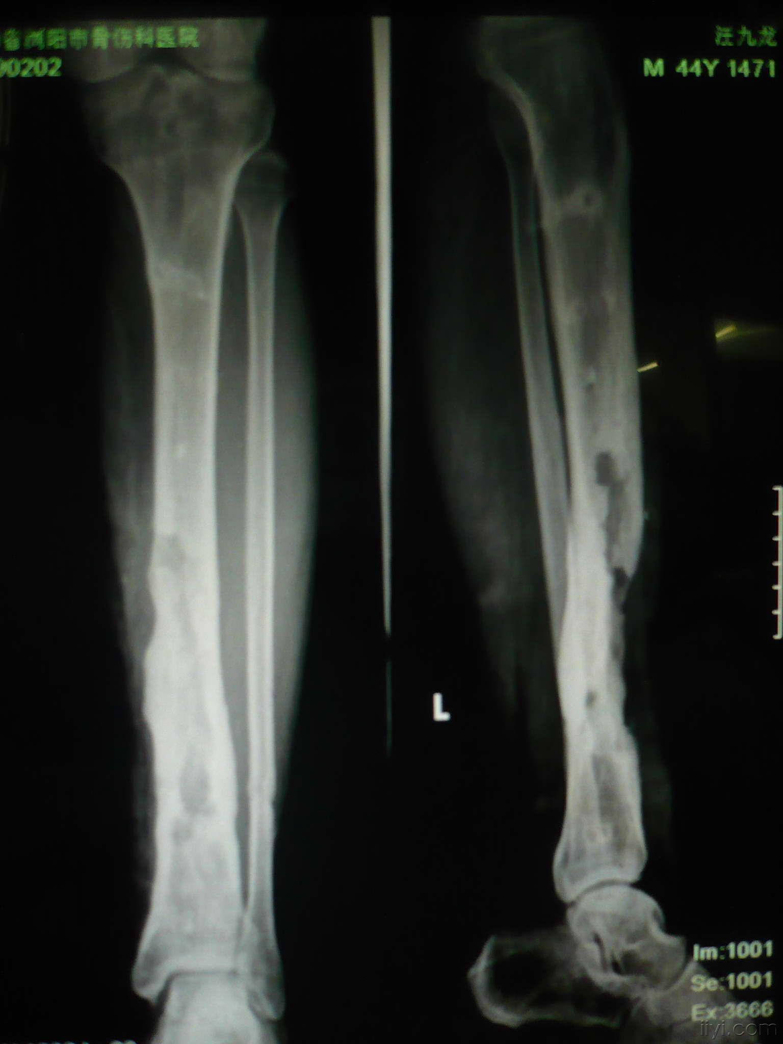 这一例胫骨慢性骨髓炎大家有啥好建议