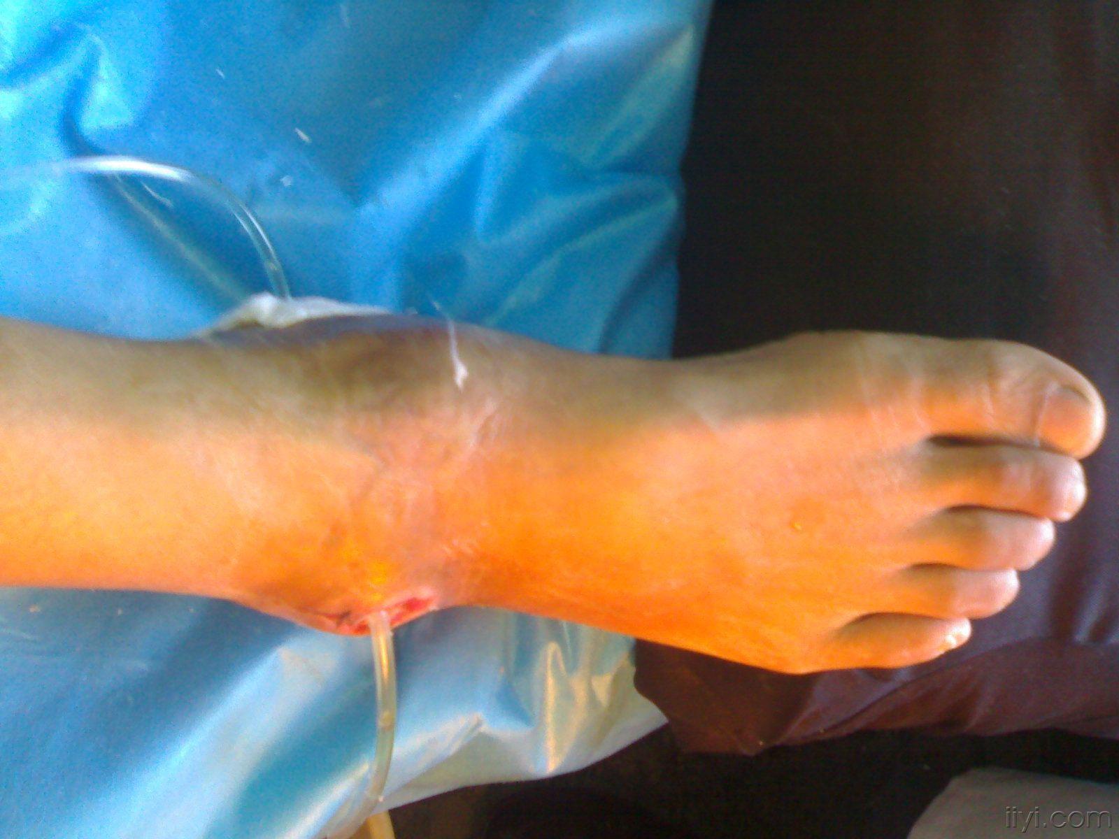 求踝关节骨髓炎治疗方案(附图片和x光片)