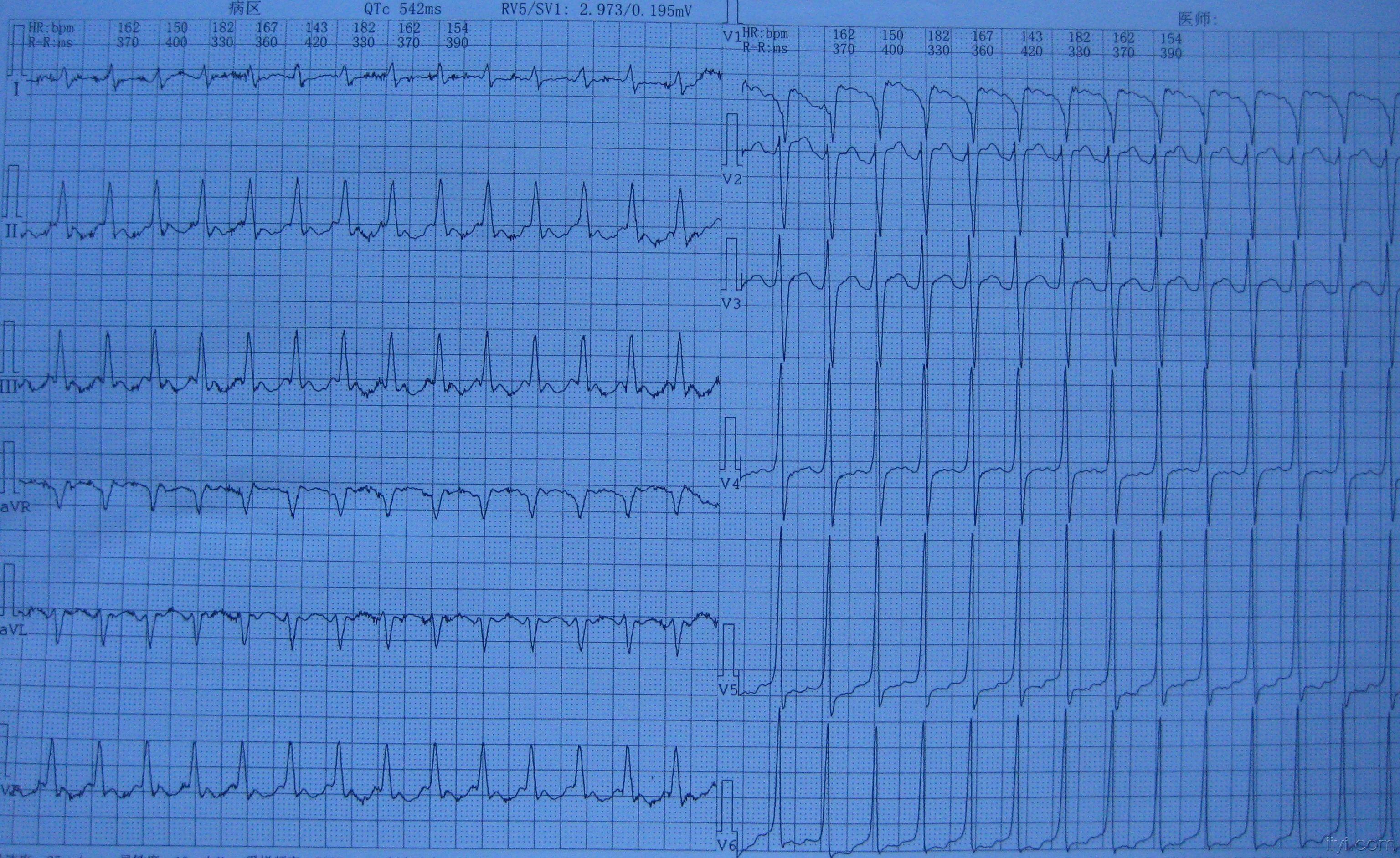 2:1房扑还是室上速 - 心电图脑电图专业讨论版 - 爱爱医医学论坛