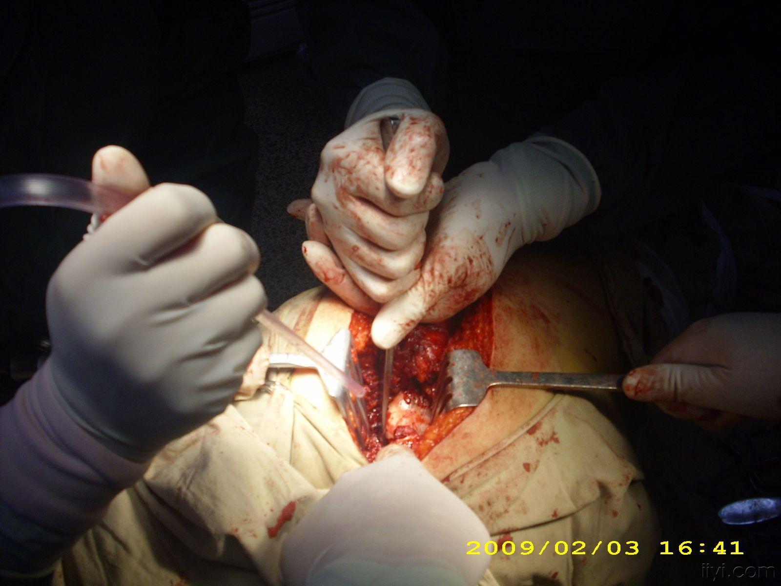 耻骨骨折手术图片