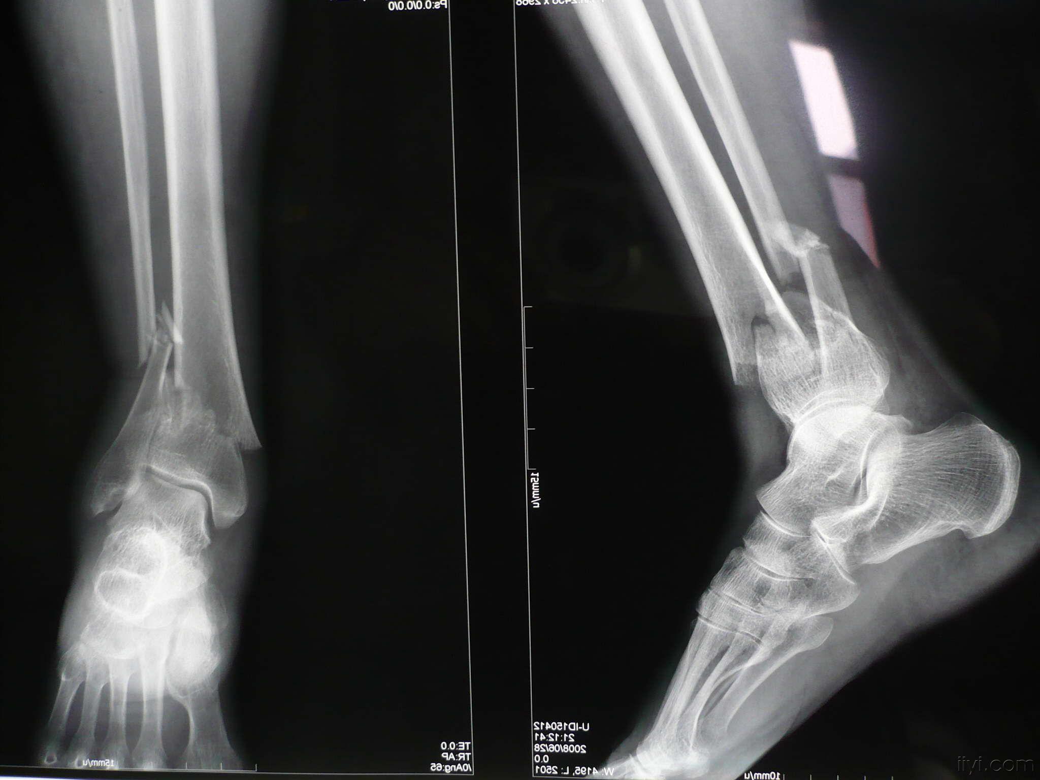 【病例讨论】左胫腓骨骨折,左小腿碾压伤半月!