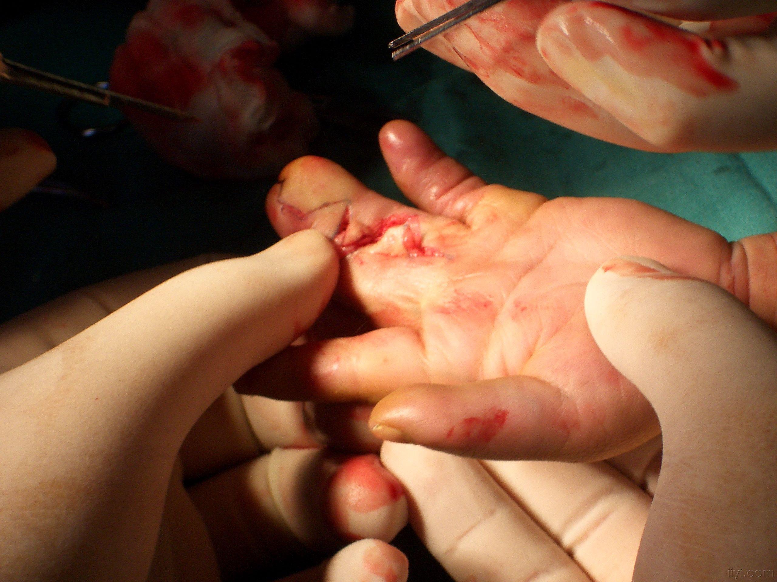 并指分指手术设计