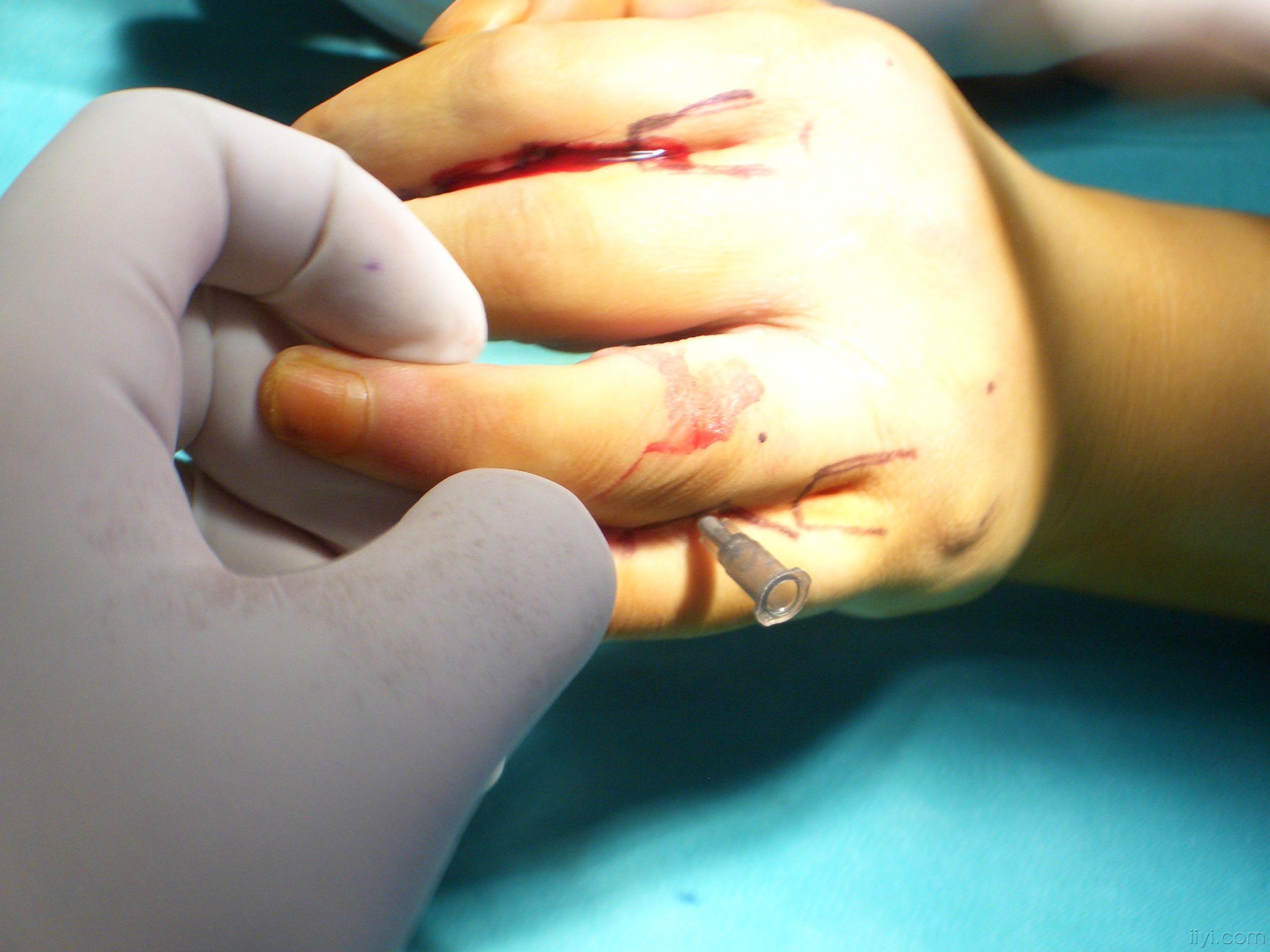 并指分指手术设计