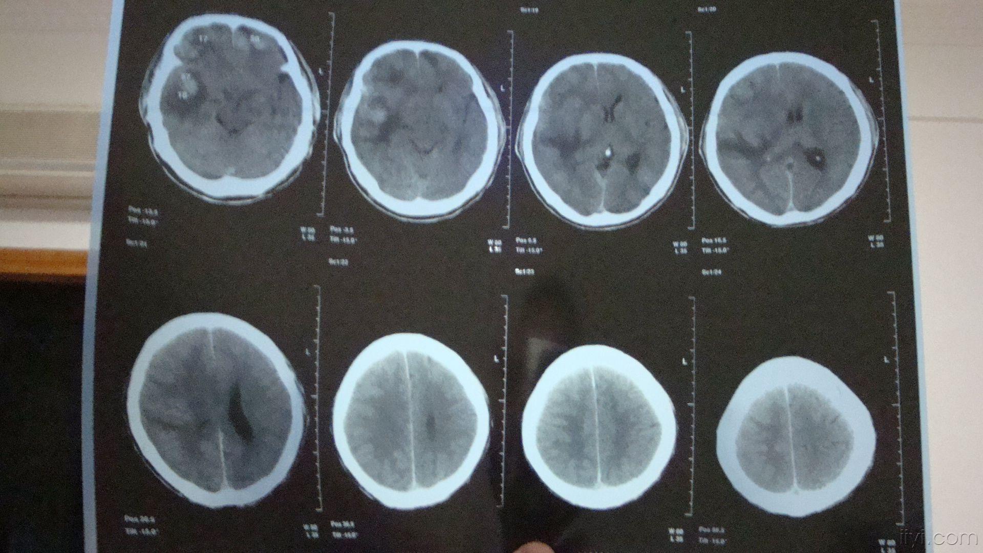 求助雙側額顳葉挫裂傷並出血