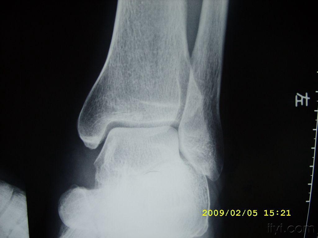 左脚踝图 20090207_8919efef37cad51226b8TePp9nNx3kFW.jpg