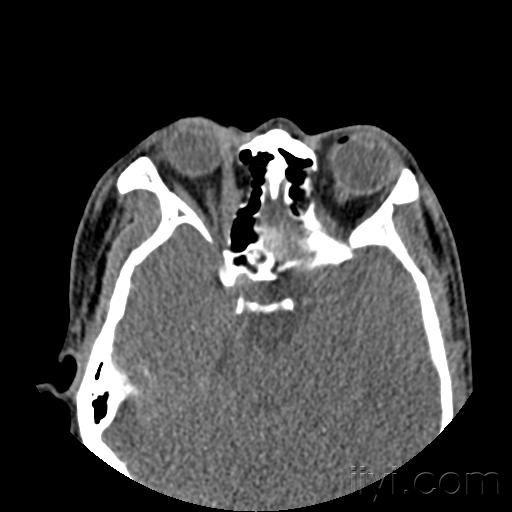 眼眶内侧壁骨折ct图片图片