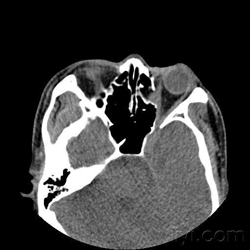 眼眶内侧壁骨折ct图片图片