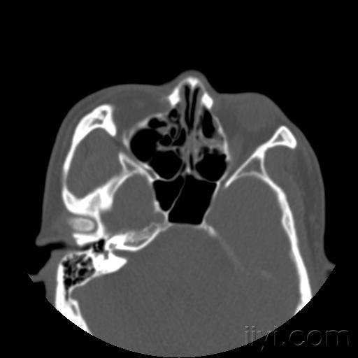眼眶内壁骨折新鲜还是陈旧性
