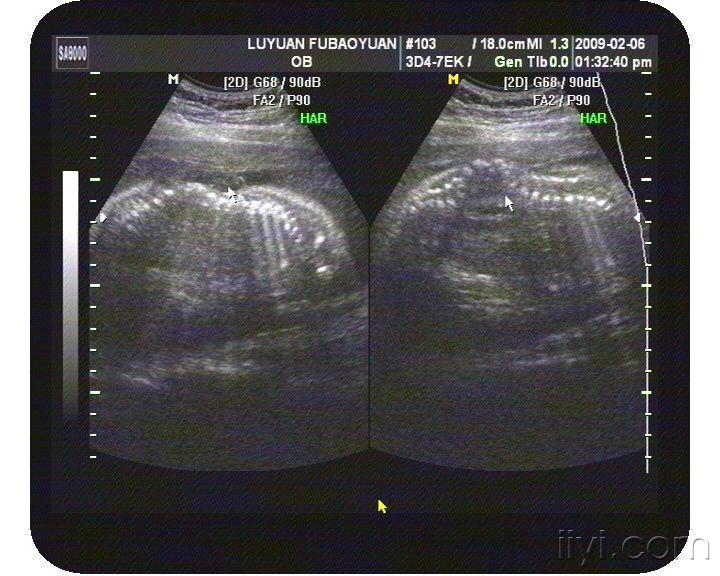 再发一例胎儿畸形(脊柱裂伴脊膜膨出,脑积水)