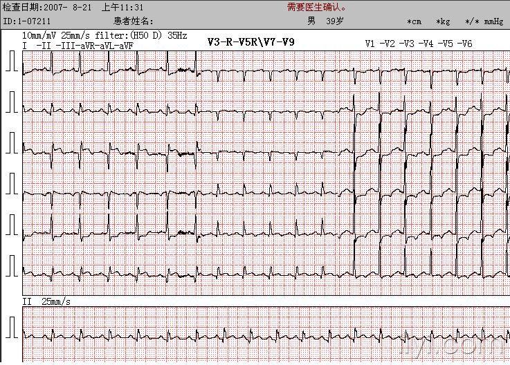 求图后壁心梗的心电图