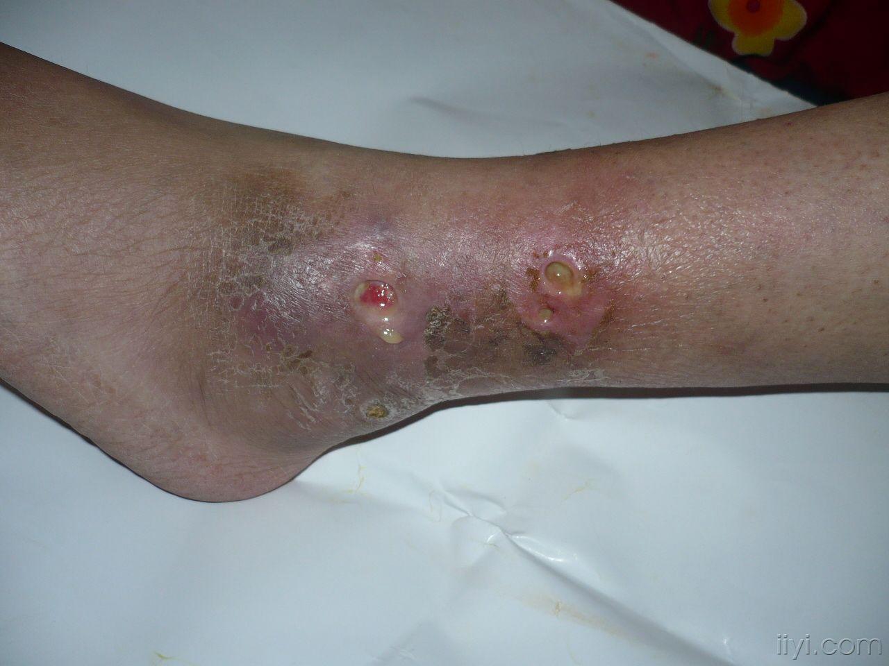 系统性红斑狼疮并下肢溃疡化脓