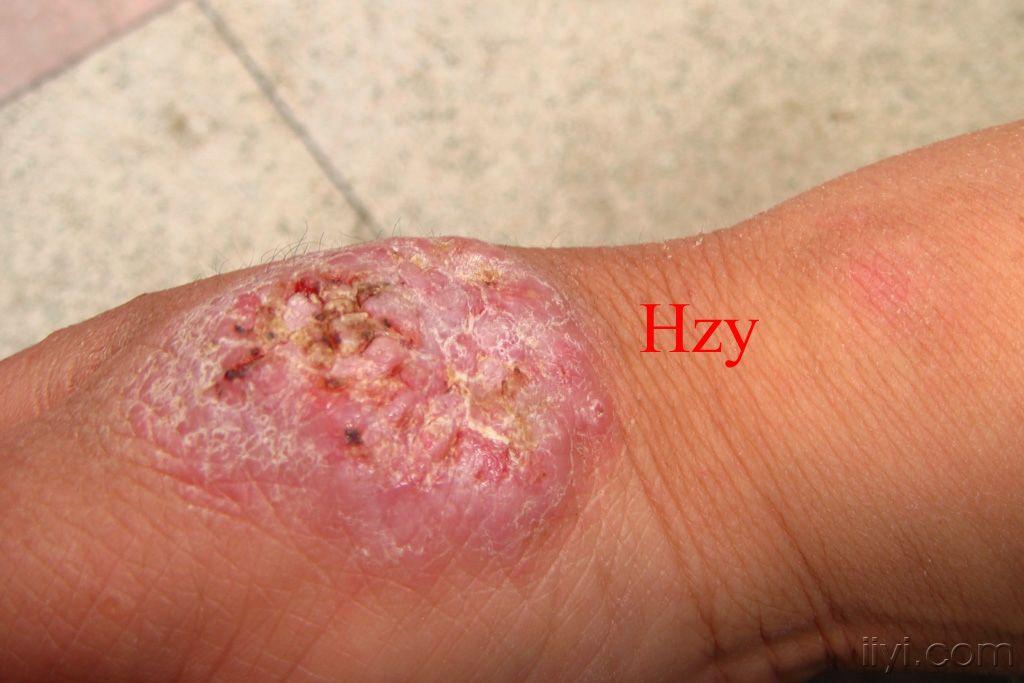 右手背皮损五年曾在宁波三院外科动手术切除皮损反而扩大