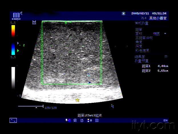 典型皮脂腺囊肿请欣赏 - 超声医学讨论版 - 爱爱医医学论坛