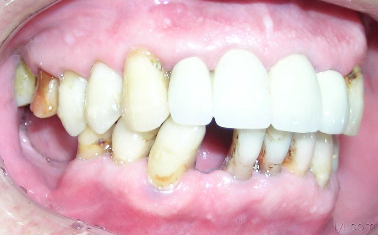 精密附着体修复双端游离端缺失