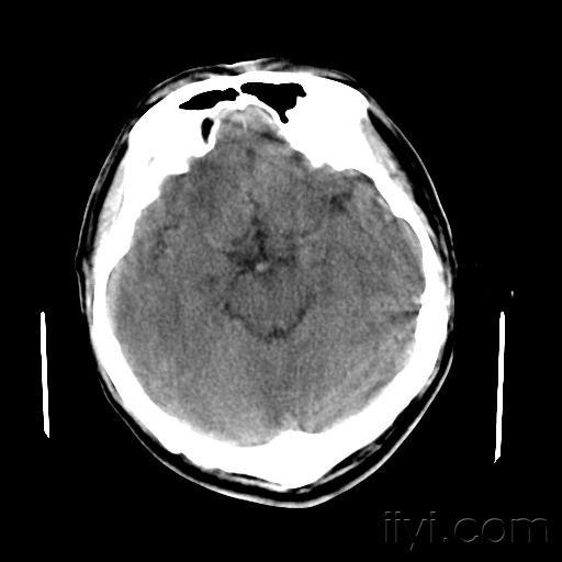 跟踪病例co中毒近远期脑改变脑白质疏松症