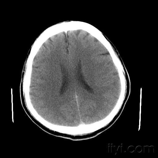 跟踪病例co中毒近远期脑改变脑白质疏松症
