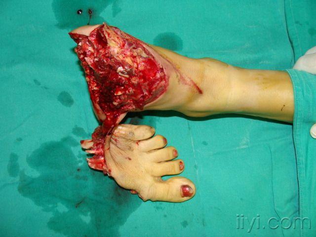 左足掌完全离断伤