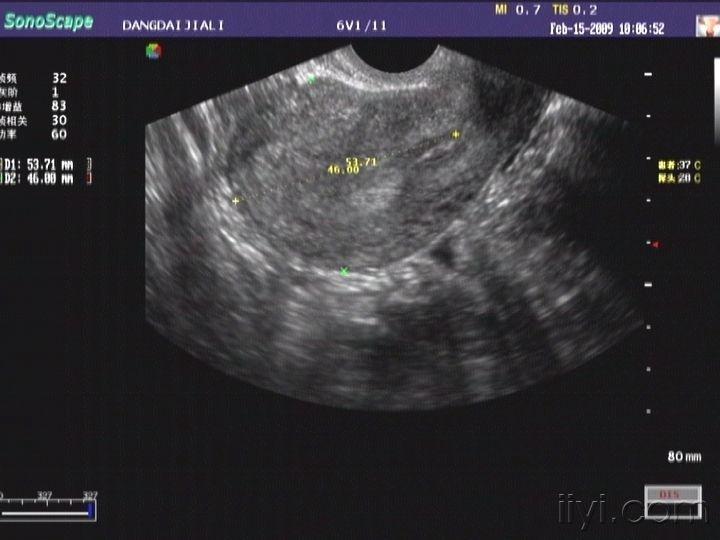 宫外孕未破裂图片 - 超声医学讨论版 - 爱爱医医学论坛