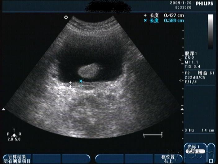 发个前列腺增生三维图