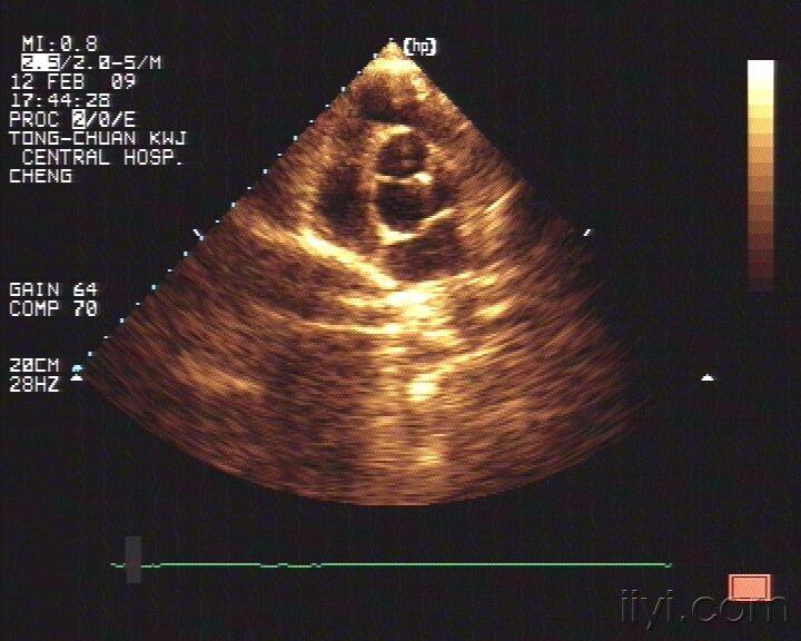 主动脉左右冠瓣交界处钙化并关闭不全