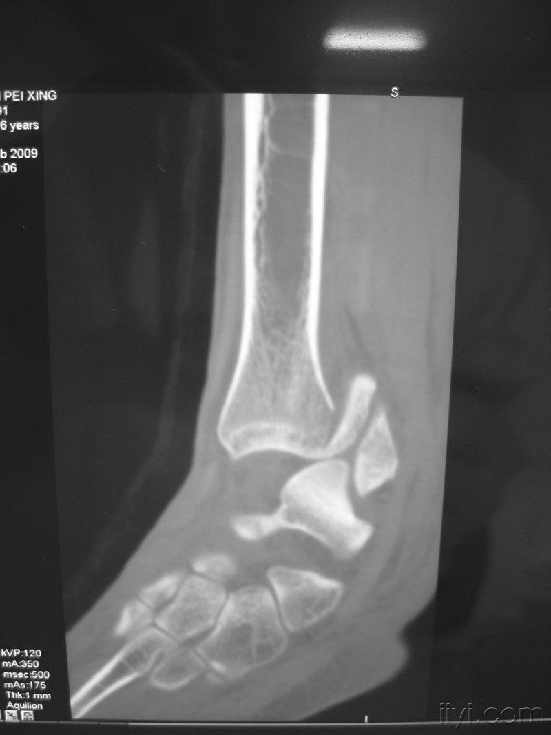 后踝骨折CT图片