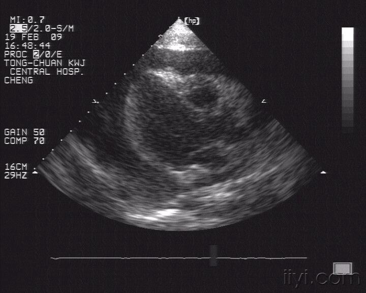 超大量心包积液 - 超声医学讨论版 - 爱爱医医学论坛
