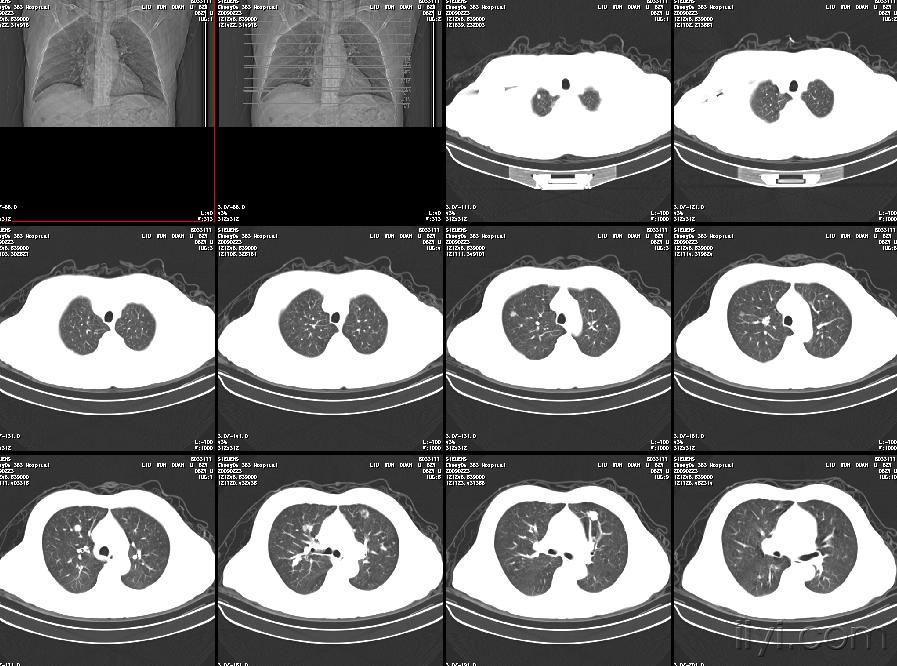 矽肺结节图片