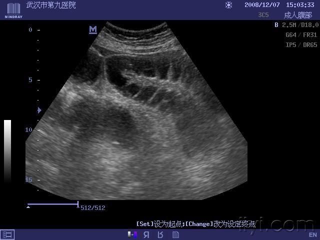 肠梗阻超声表现图片图片