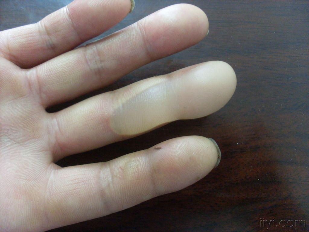 精醋酸致接触性皮炎一例 - 皮肤及性传播疾病讨论版 - 爱爱医医学论坛