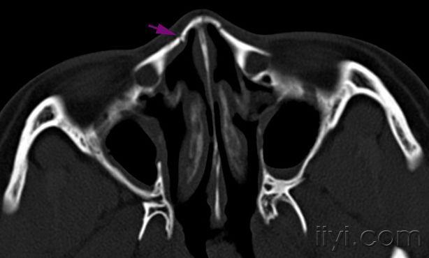 宝宝鼻子骨折ct 搜狗图片搜索