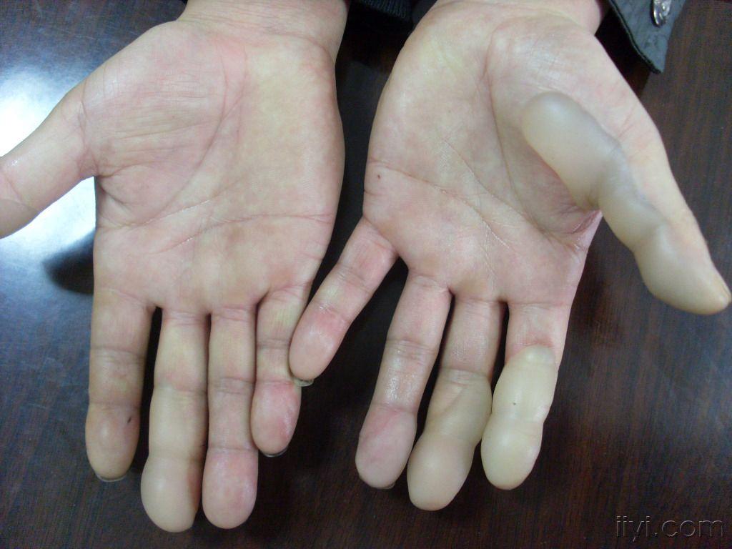 精醋酸致接触性皮炎一例 - 皮肤及性传播疾病讨论版 - 爱爱医医学论坛