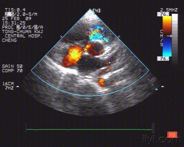 主动脉窦瘤超声图片