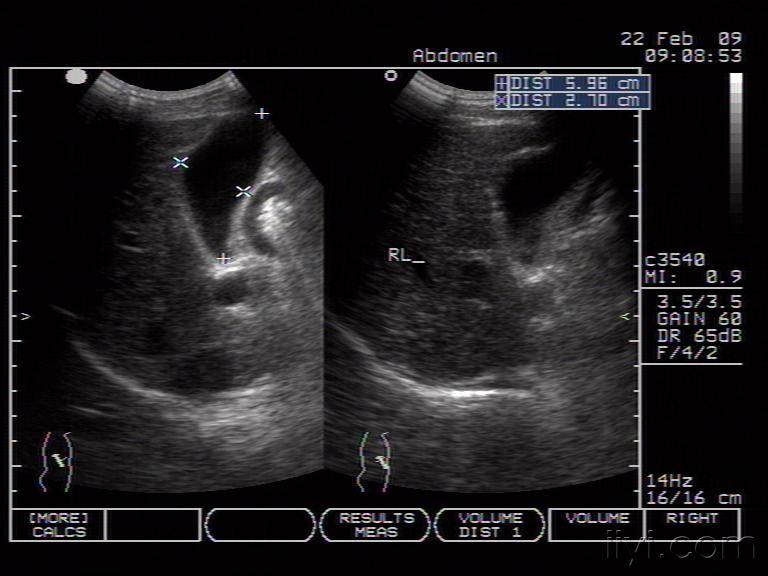 肝硬化巨脾 - 超聲醫學討論版 - 愛愛醫醫學論壇