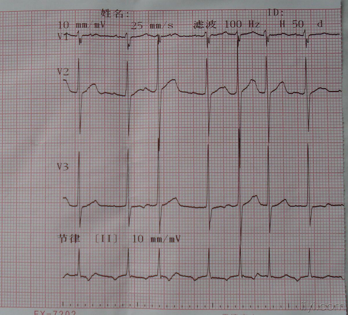楚-请大家看看(14) - 心电图脑电图专业讨论版 - 爱爱医医学论坛