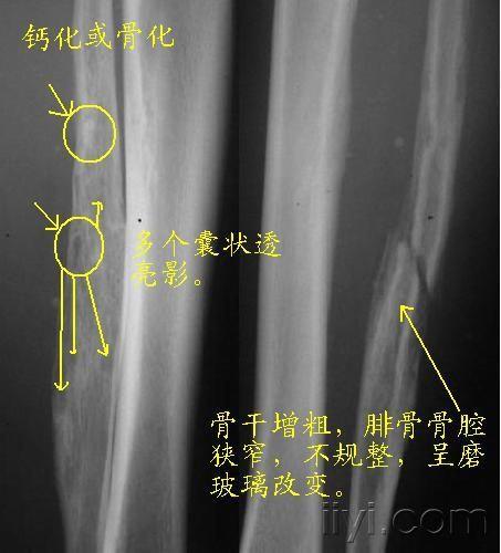 骨纤维异常增殖症伴病理性骨折一例