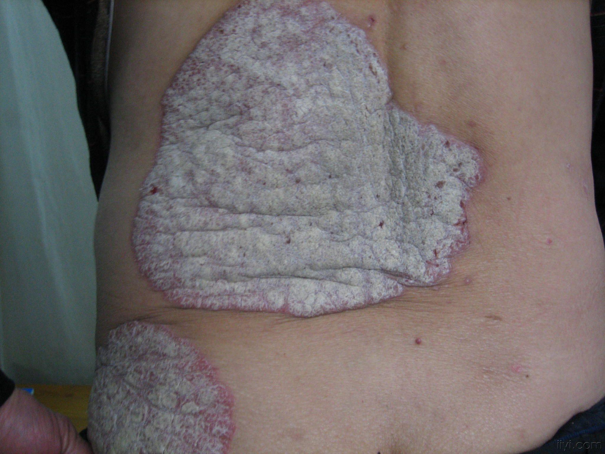 典型的斑块状银屑病 - 皮肤及性传播疾病讨论版 - 爱爱医医学论坛