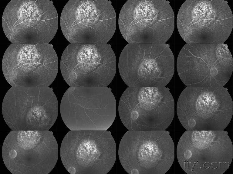 肺癌脉络膜转移