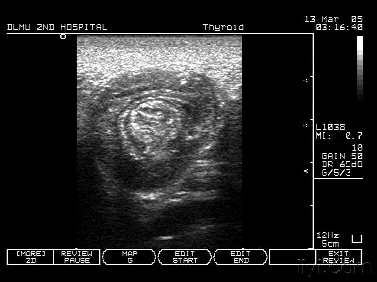 小儿肠套叠的超声图谱图片