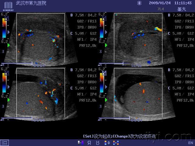 附睾,睾丸肿大,回声减低.