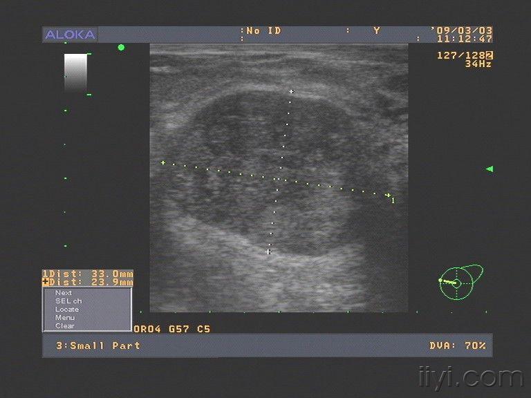 讨论乳腺纤维瘤