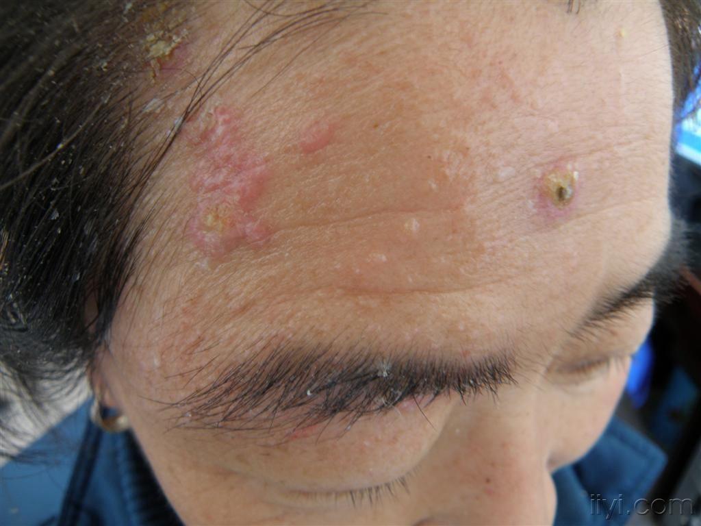 蛇盘疮最佳治疗方法是什么_治疗蛇盘疮最快的方法_刺血拔罐治疗蛇盘疮