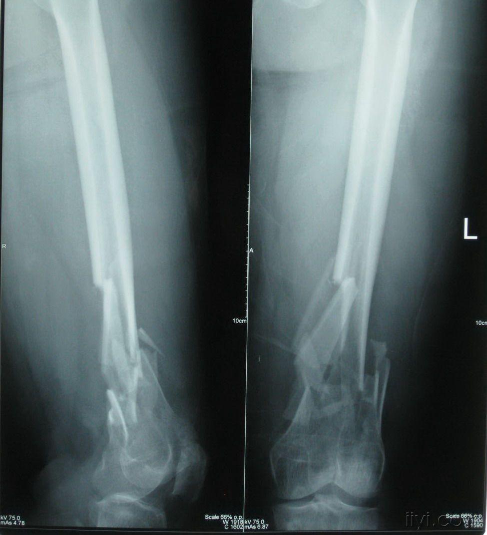 大腿粉碎性骨折图片图片