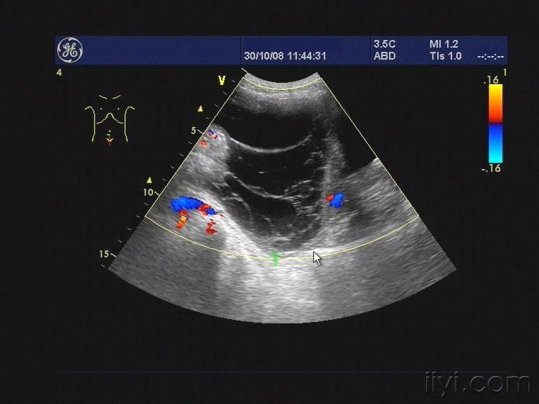 無回聲區下至盆腔,與膀胱,子宮附件關係密切.jpg